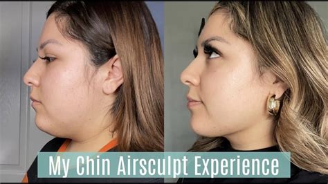 Airsculpt Cost 2024: Total Prices Range and Arms, Chin, and。